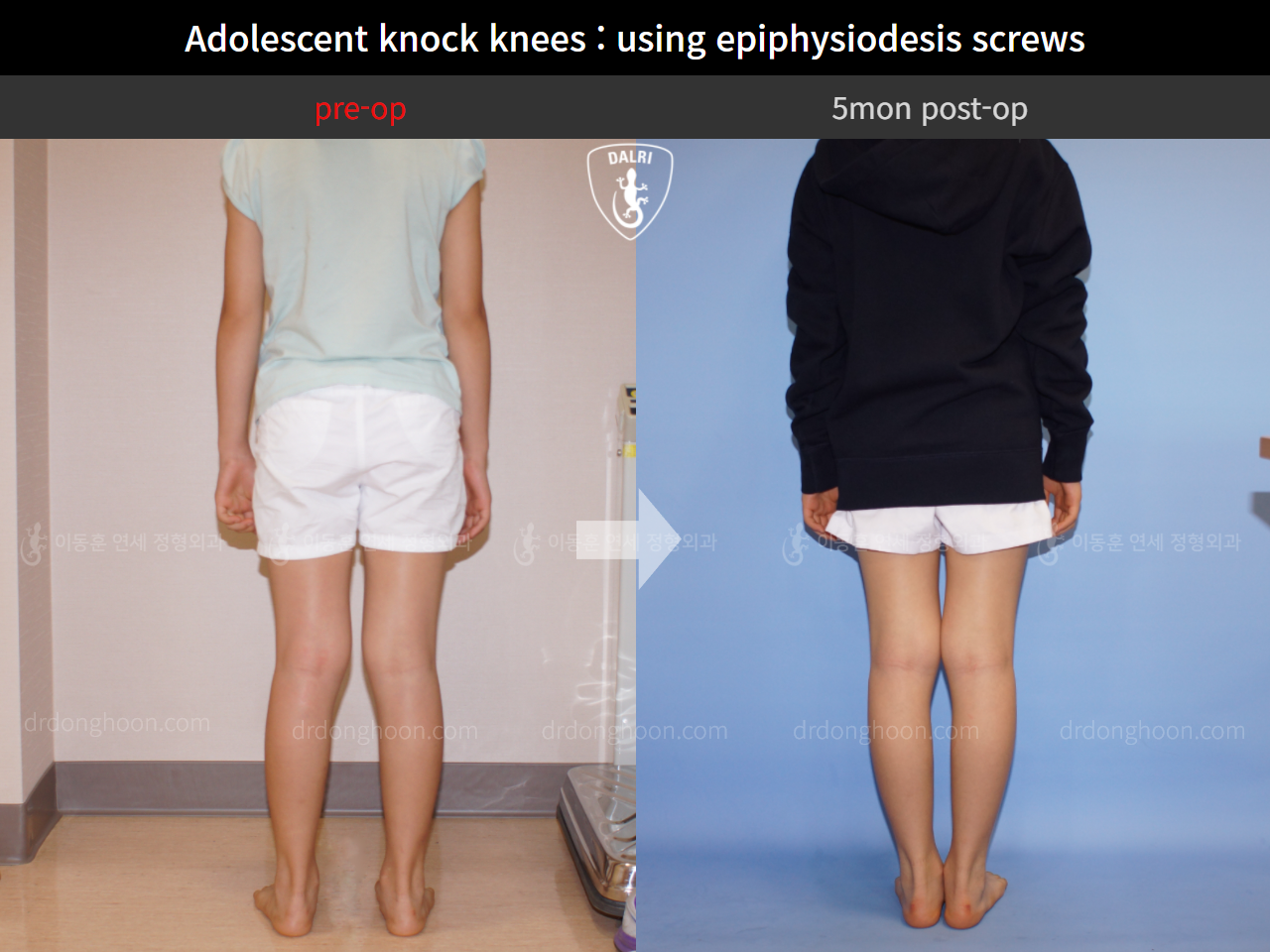 Before and after paediatric & adolescent knock knees, case 4310946, image 4, Dr. Donghoon institute (DALRI)