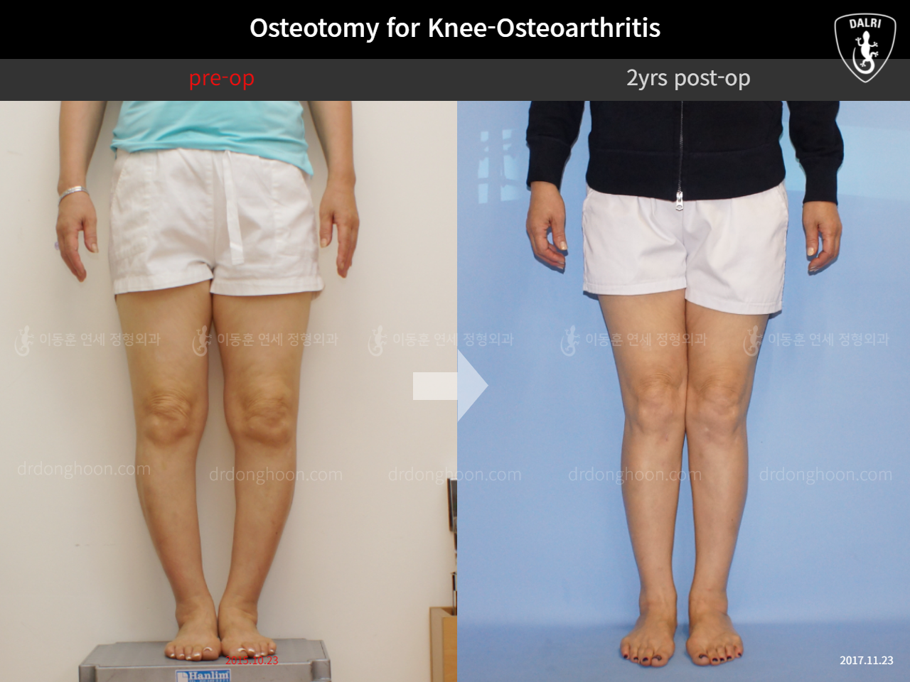 Before and after osteotomy for knee osteoarthritis, case 11785573, image 5, Dr. Donghoon institute (DALRI)