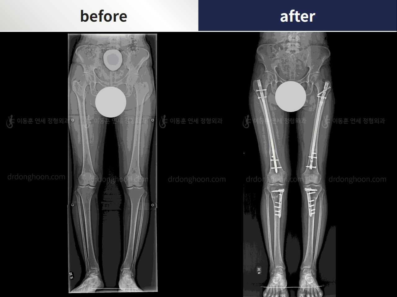 Before and after complex deformity, case 4251622, image 3, Dr. Donghoon institute (DALRI)