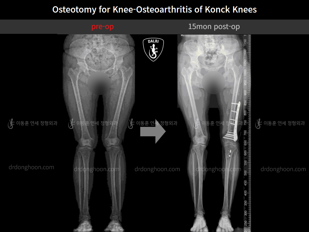 Before and after osteotomy for knee osteoarthritis, case 10868309, image 2, Dr. Donghoon institute (DALRI)