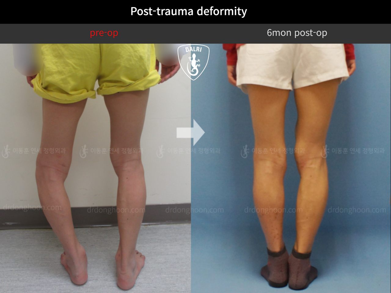 Before and after post-trauma deformity, case 8021097, image 2, Dr. Donghoon institute (DALRI)