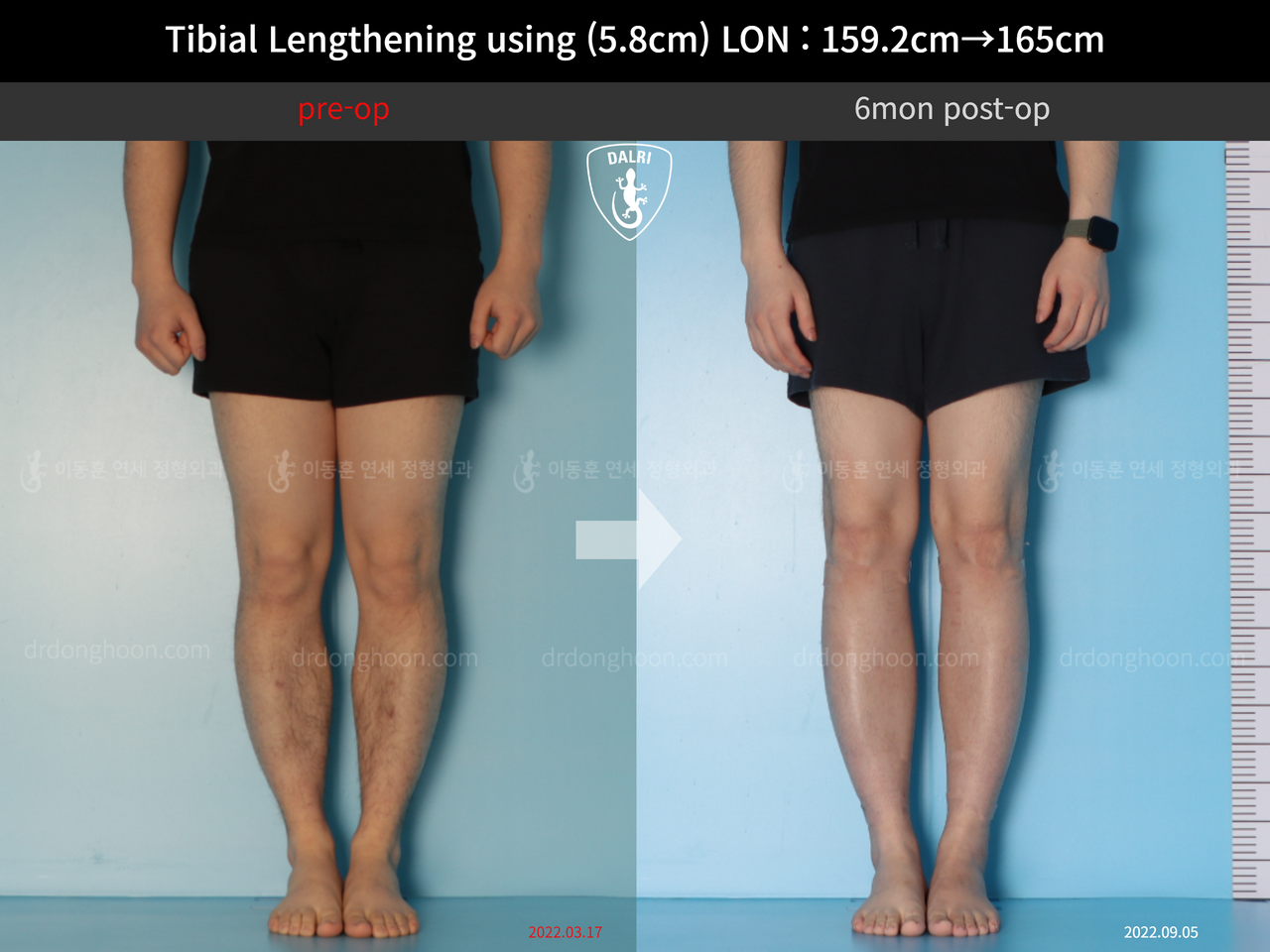 Before and after cll lon, case 12791053, image 5, Dr. Donghoon institute (DALRI)