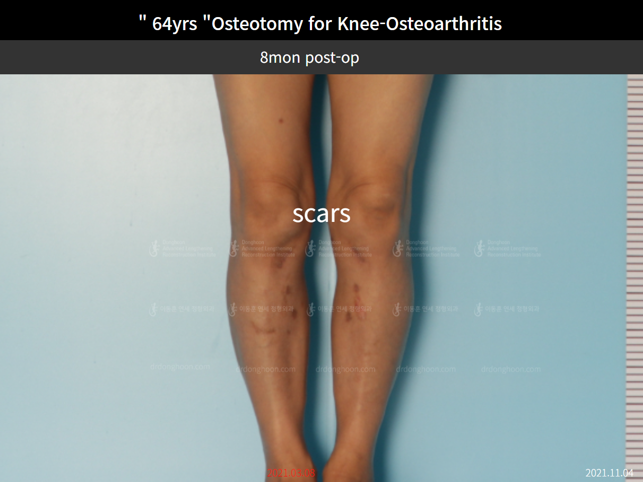 Before and after osteotomy for knee osteoarthritis, case 8761106, image 5, Dr. Donghoon institute (DALRI)