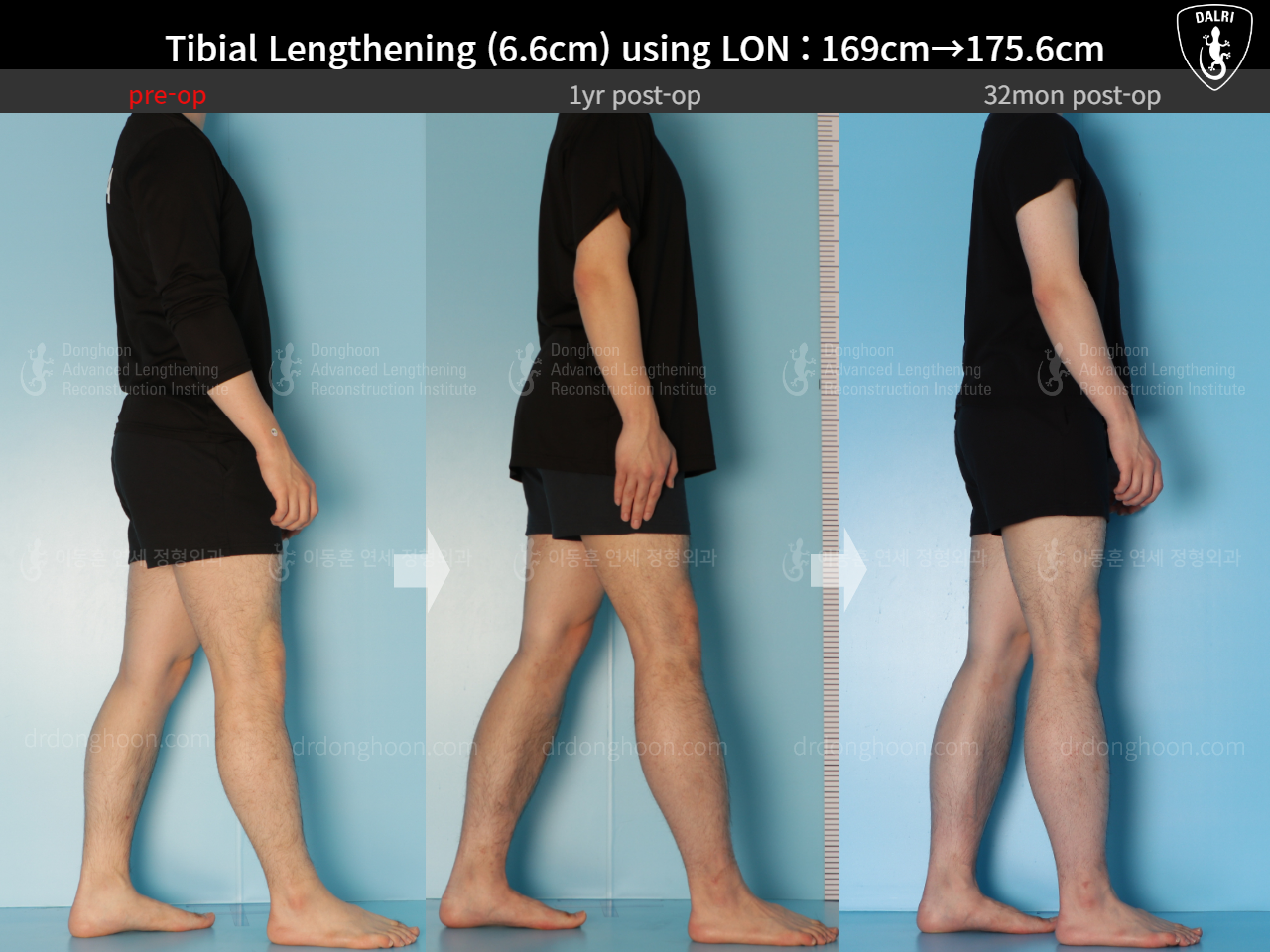 Before and after cll lon, case 15166302, image 3, Dr. Donghoon institute (DALRI)