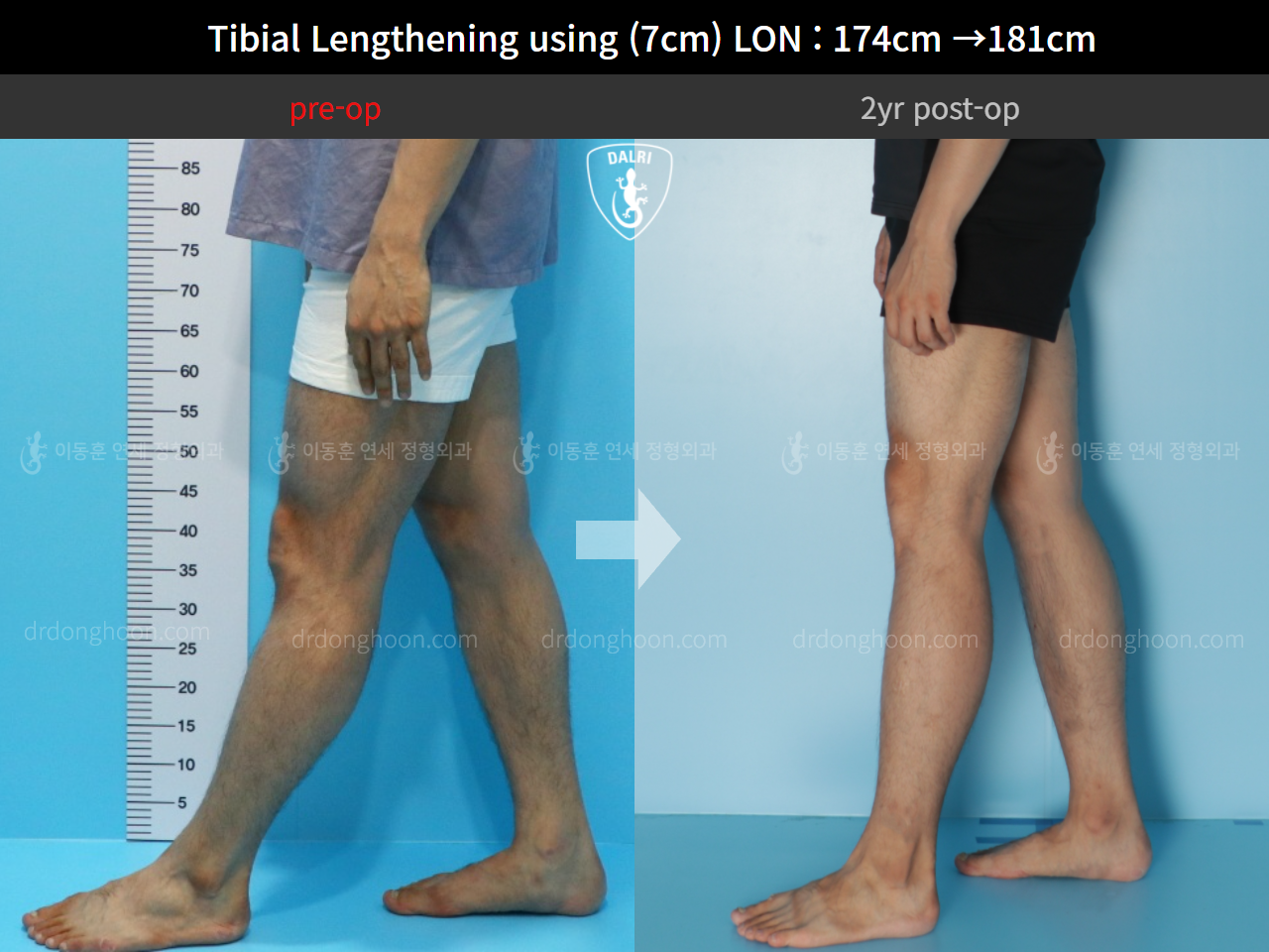 Before and after cll lon, case 5316185, image 8, Dr. Donghoon institute (DALRI)