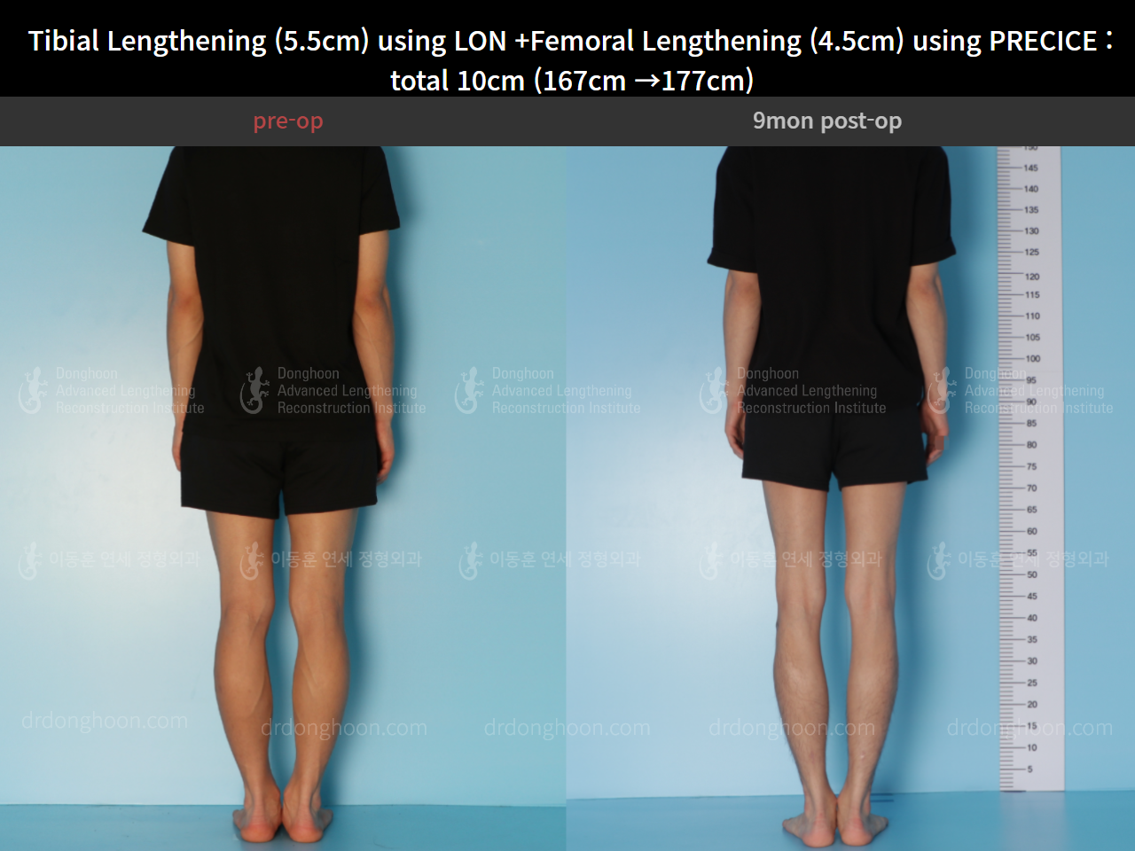Before and after cll precice, case 4662233, image 2, Dr. Donghoon institute (DALRI)