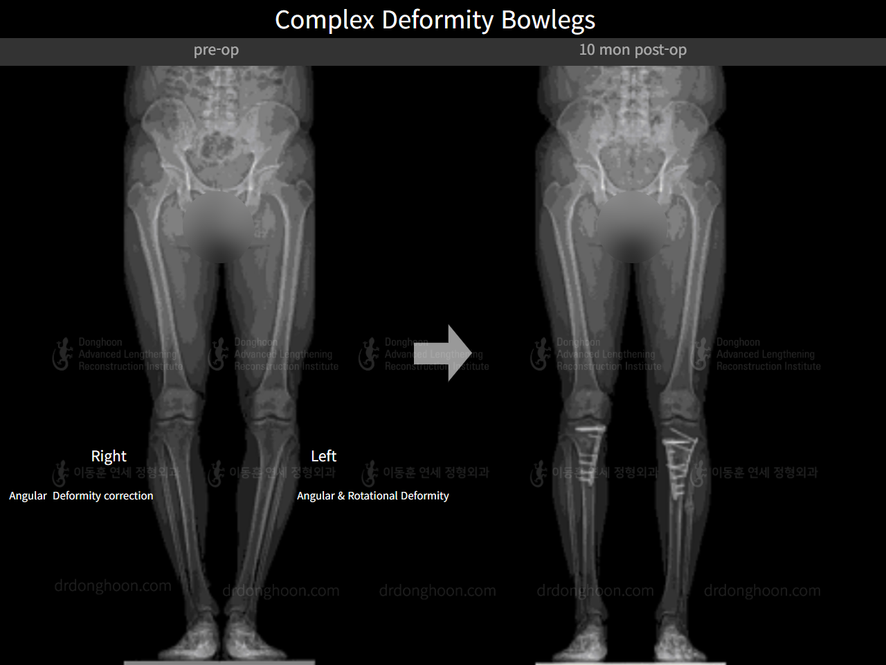 Before and after adult bowlegs, case 7809748, image 2, Dr. Donghoon institute (DALRI)