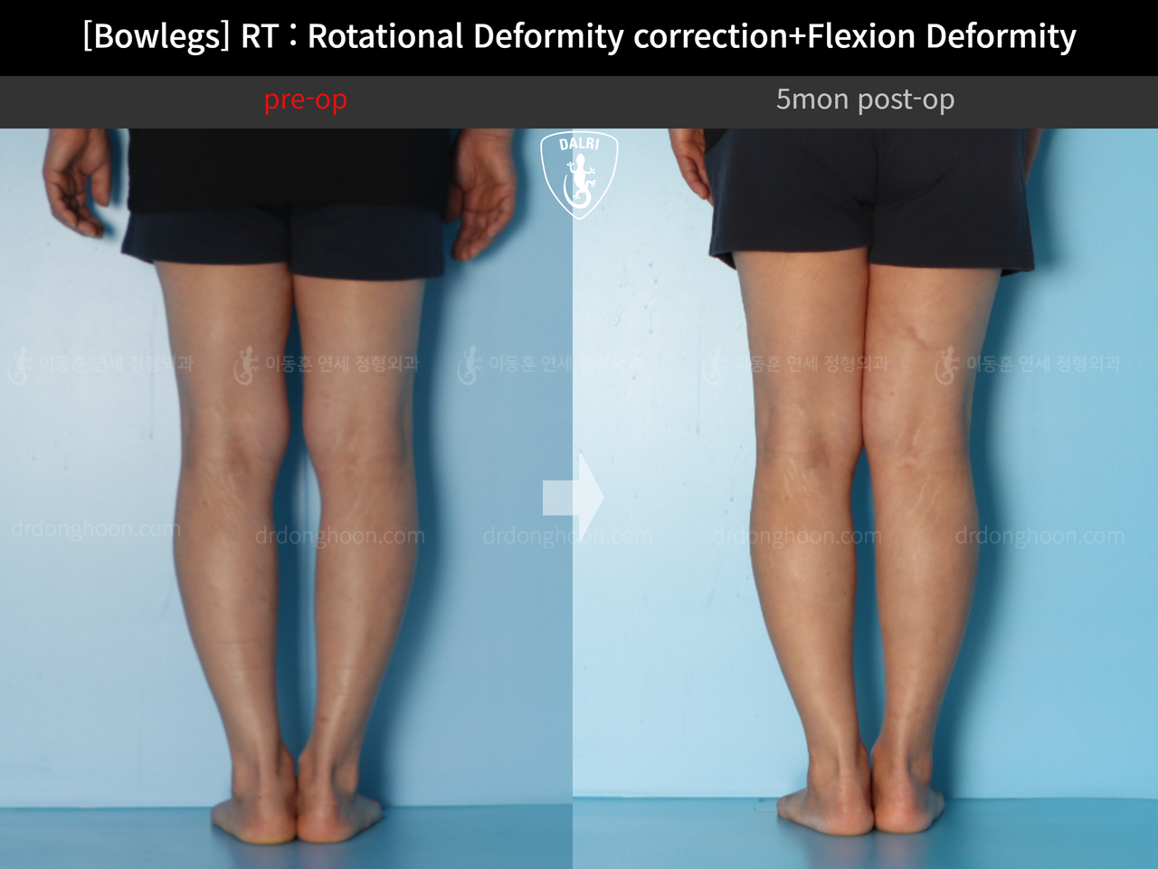 Before and after adult bowlegs, case 13668670, image 5, Dr. Donghoon institute (DALRI)