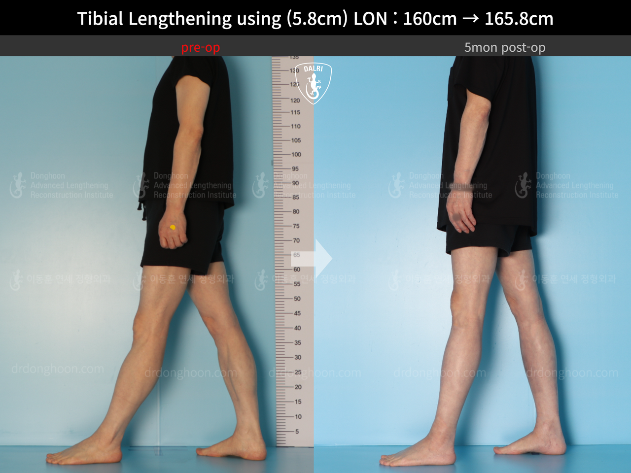 ภาพก่อน-หลัง ยืดขาเทคนิค LON เคสที่ 13414044 ภาพที่ 4 จากโรงพยาบาลศัลยกรรมกระดูกลีดงฮุน (DALRI)