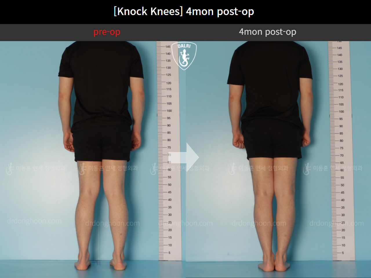 Before and after adult knock knees, case 10599771, image 2, Dr. Donghoon institute (DALRI)