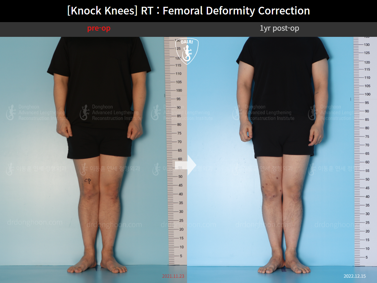 Before and after adult knock knees, case 15950751, image 4, Dr. Donghoon institute (DALRI)
