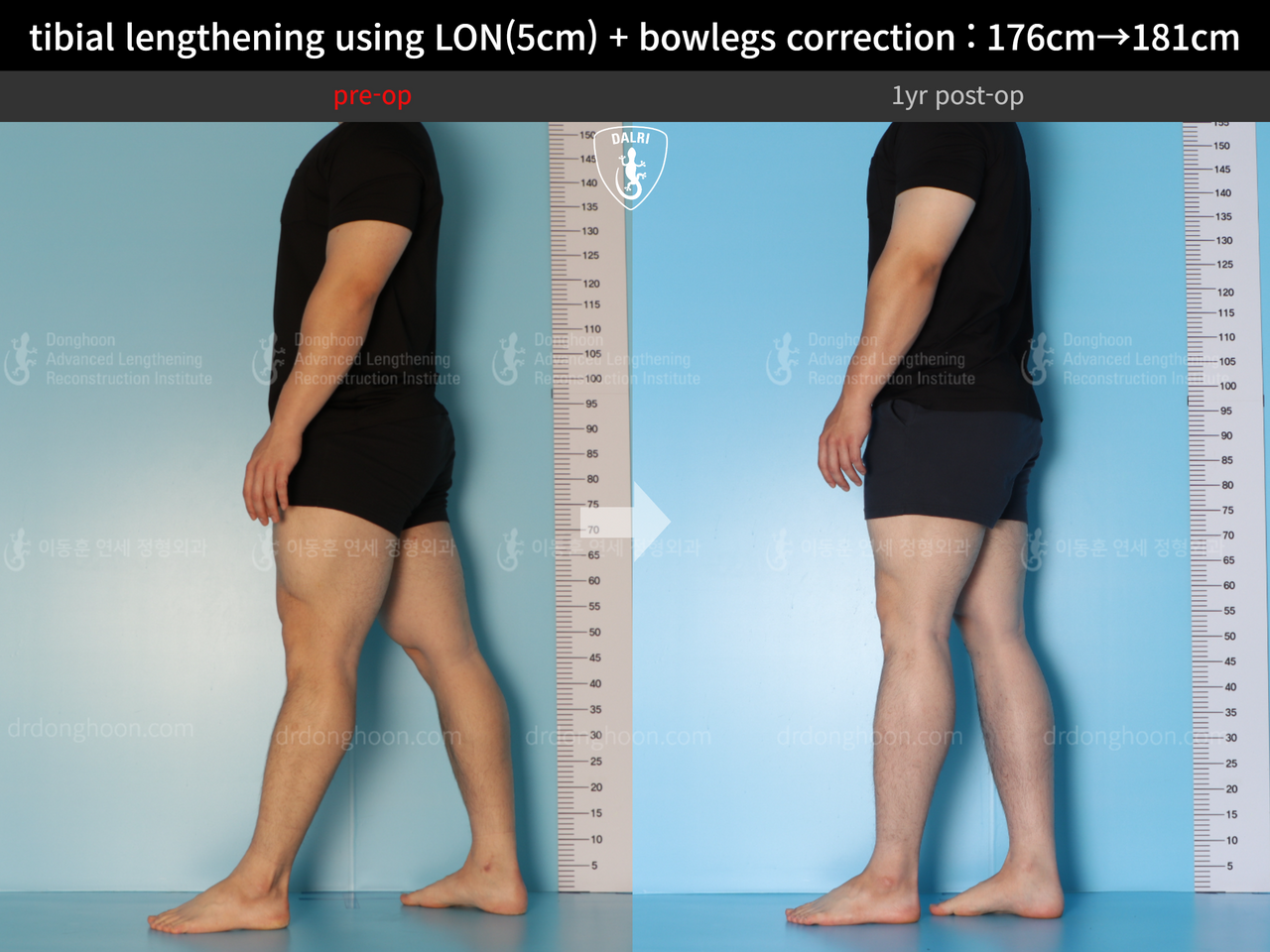 Before and after cll + deformity correction, case 13410849, image 6, Dr. Donghoon institute (DALRI)