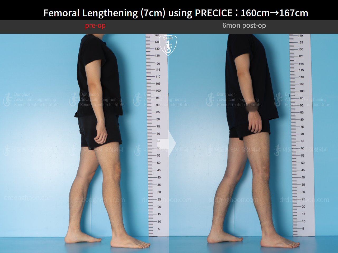 Before and after cll precice, case 15460533, image 7, Dr. Donghoon institute (DALRI)