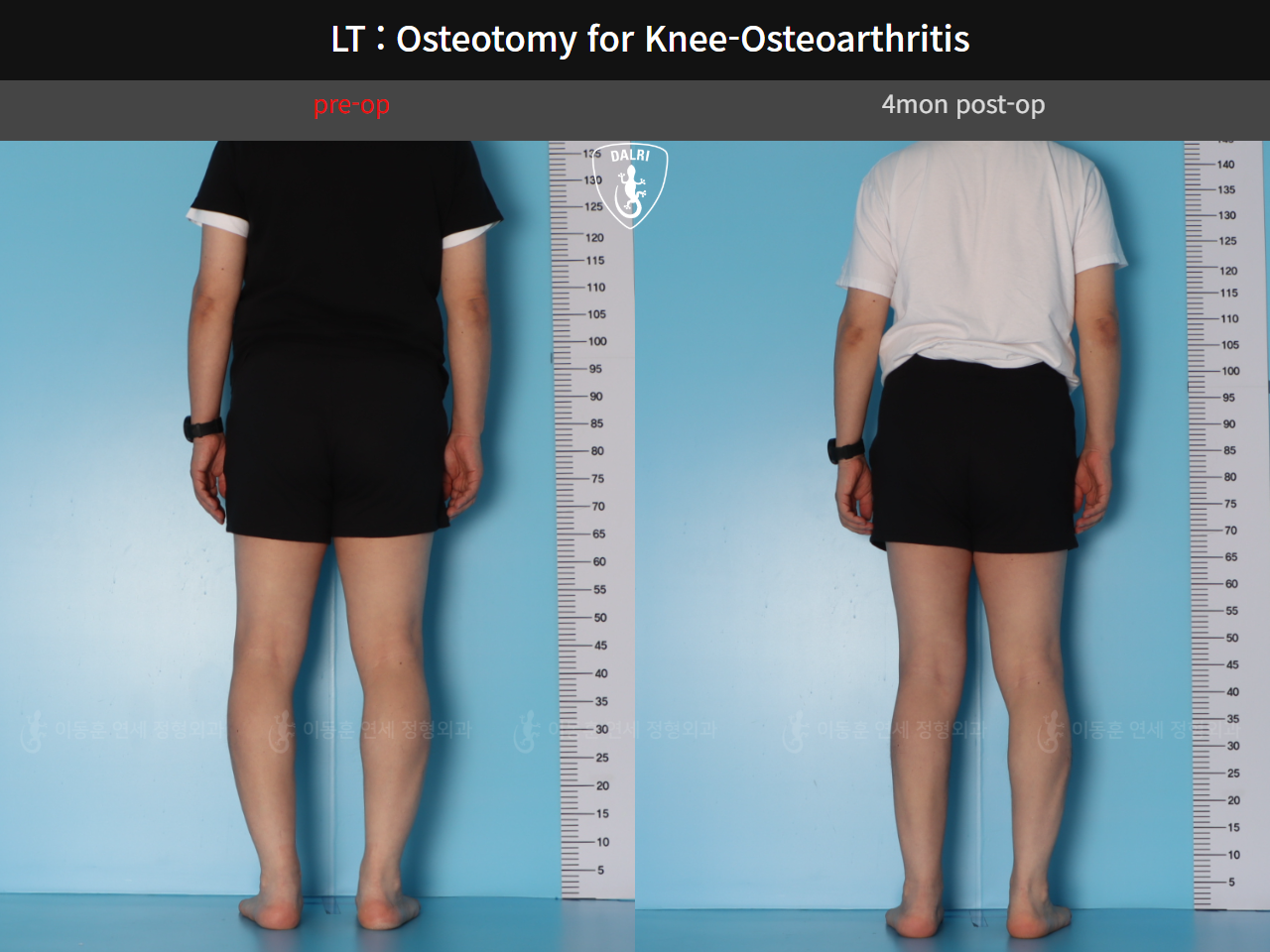 Before and after osteotomy for knee osteoarthritis, case 128374850, image 4, Dr. Donghoon institute (DALRI)