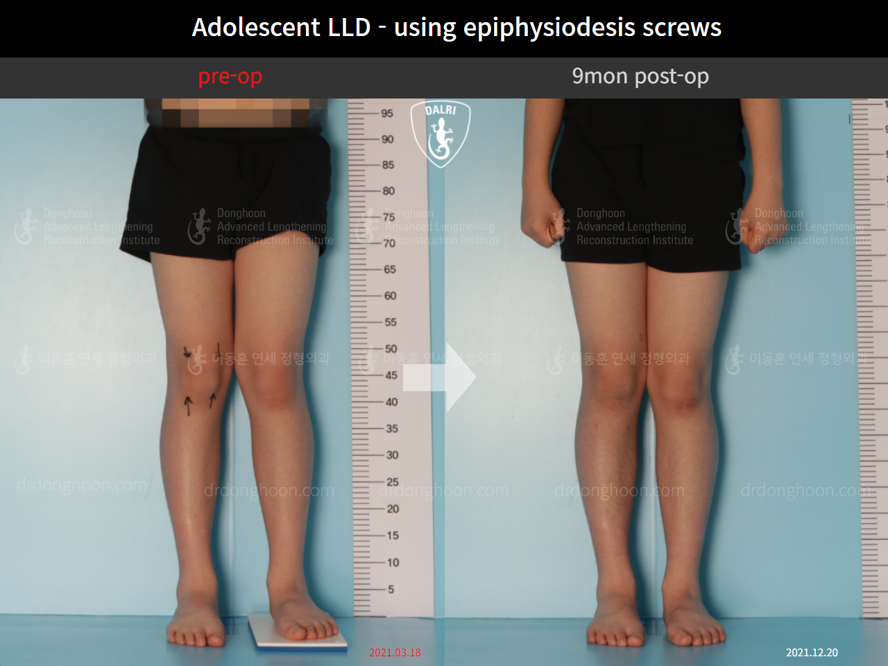 Before and after paediatric & adolescent lld, case 9572577, image 4, Dr. Donghoon institute (DALRI)