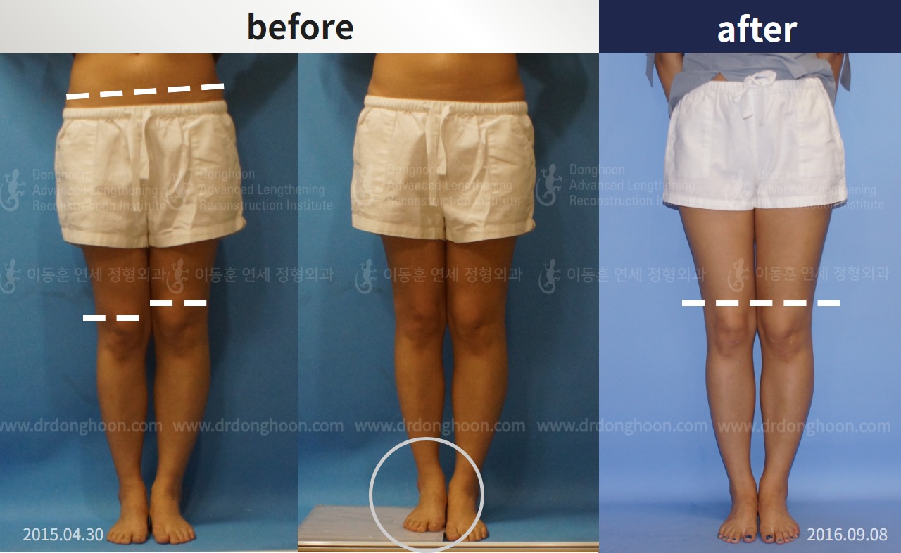Before and after adult lld, case 4320289, image 1, Dr. Donghoon institute (DALRI)