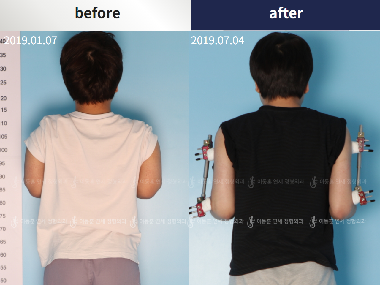 Before and after arm lengthening, case 4249423, image 1, Dr. Donghoon institute (DALRI)