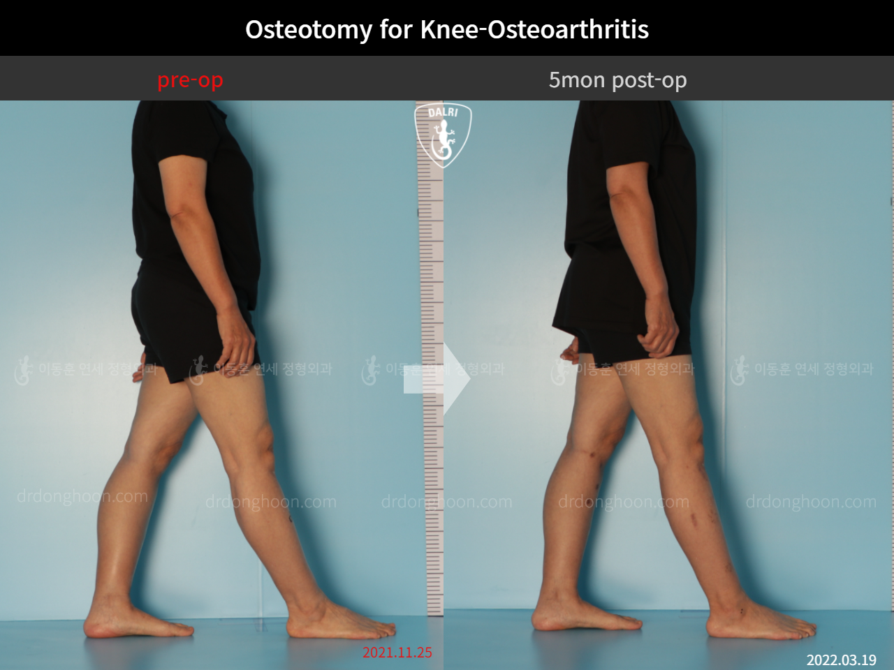 Before and after osteotomy for knee osteoarthritis, case 11047064, image 3, Dr. Donghoon institute (DALRI)