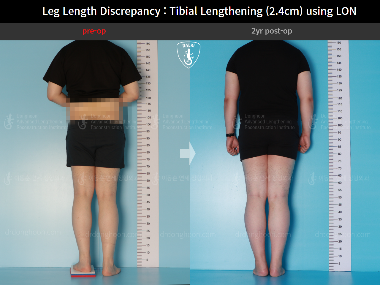 Before and after adult lld, case 15877698, image 2, Dr. Donghoon institute (DALRI)