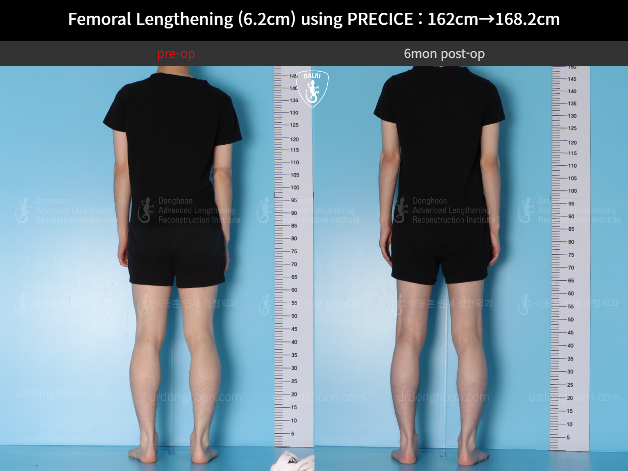 Before and after cll precice, case 15393865, image 4, Dr. Donghoon institute (DALRI)