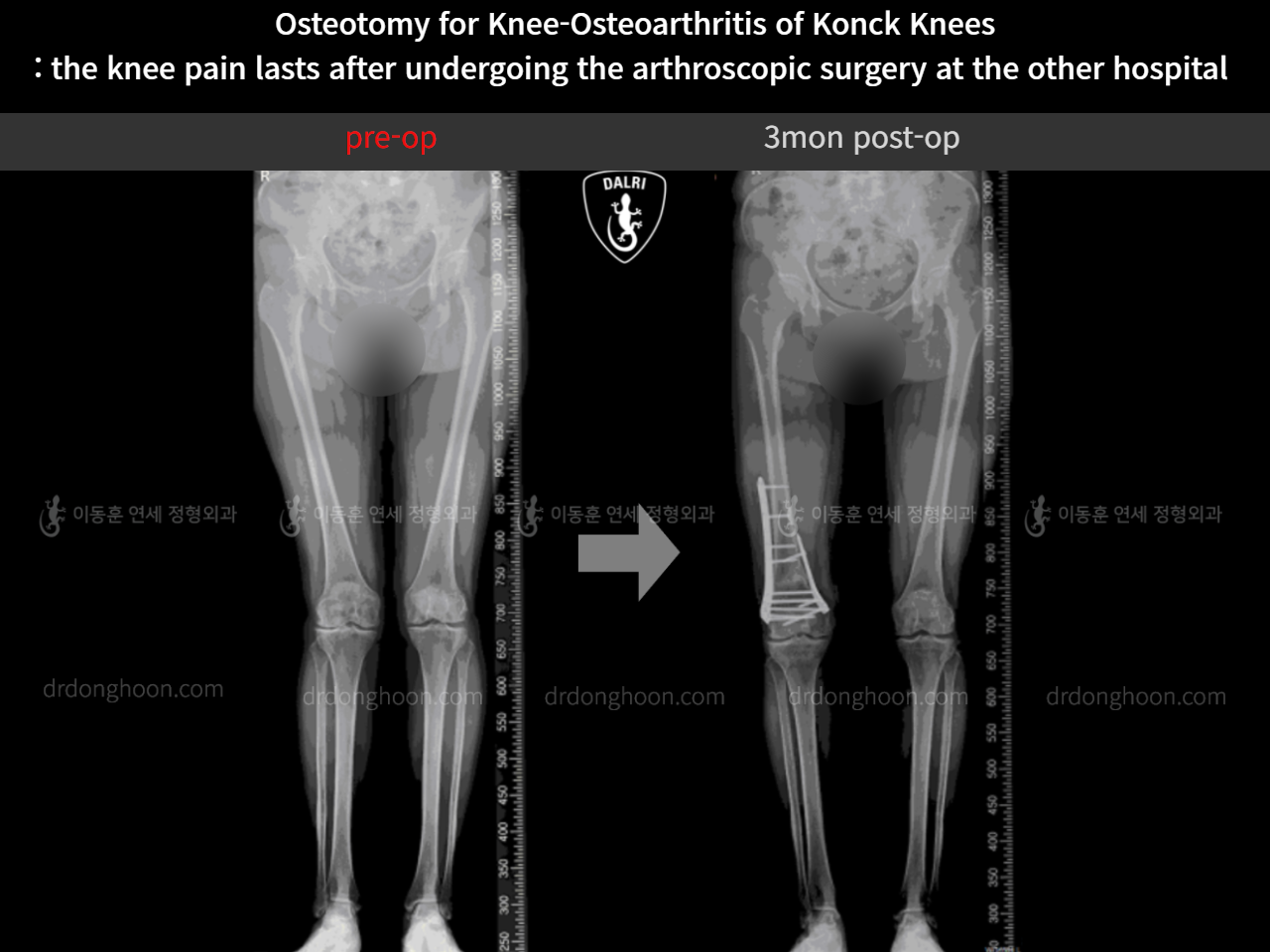 Before and after reoperation after deformity correction, case 10664605, image 6, Dr. Donghoon institute (DALRI)