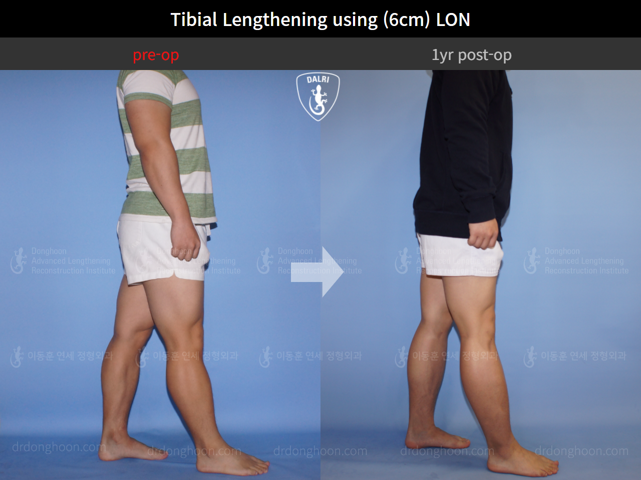 Before and after cll lon, case 4323461, image 4, Dr. Donghoon institute (DALRI)