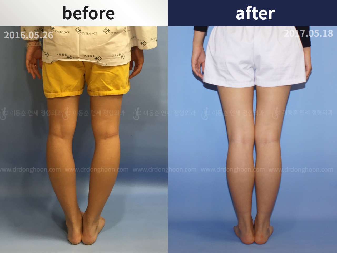 Before and after paediatric & adolescent bowlegs, case 4320280, image 2, Dr. Donghoon institute (DALRI)