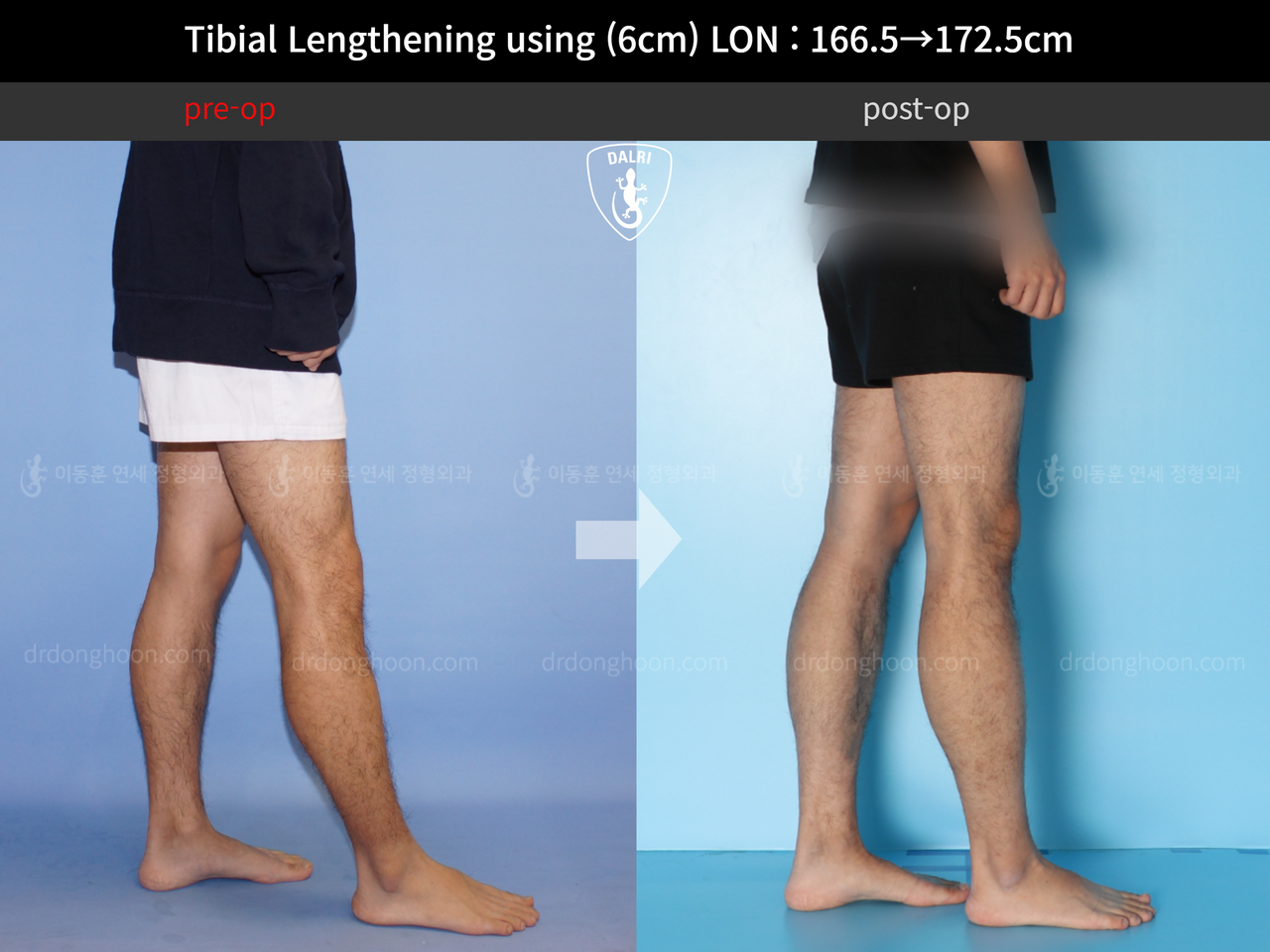 Before and after cll lon, case 11980239, image 7, Dr. Donghoon institute (DALRI)