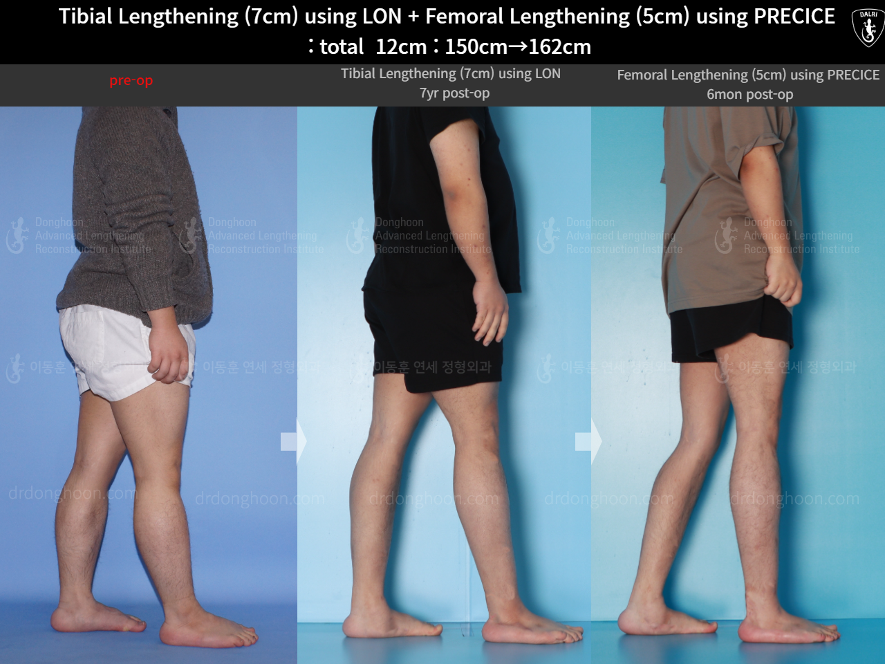 Before and after cll precice, case 16146445, image 3, Dr. Donghoon institute (DALRI)