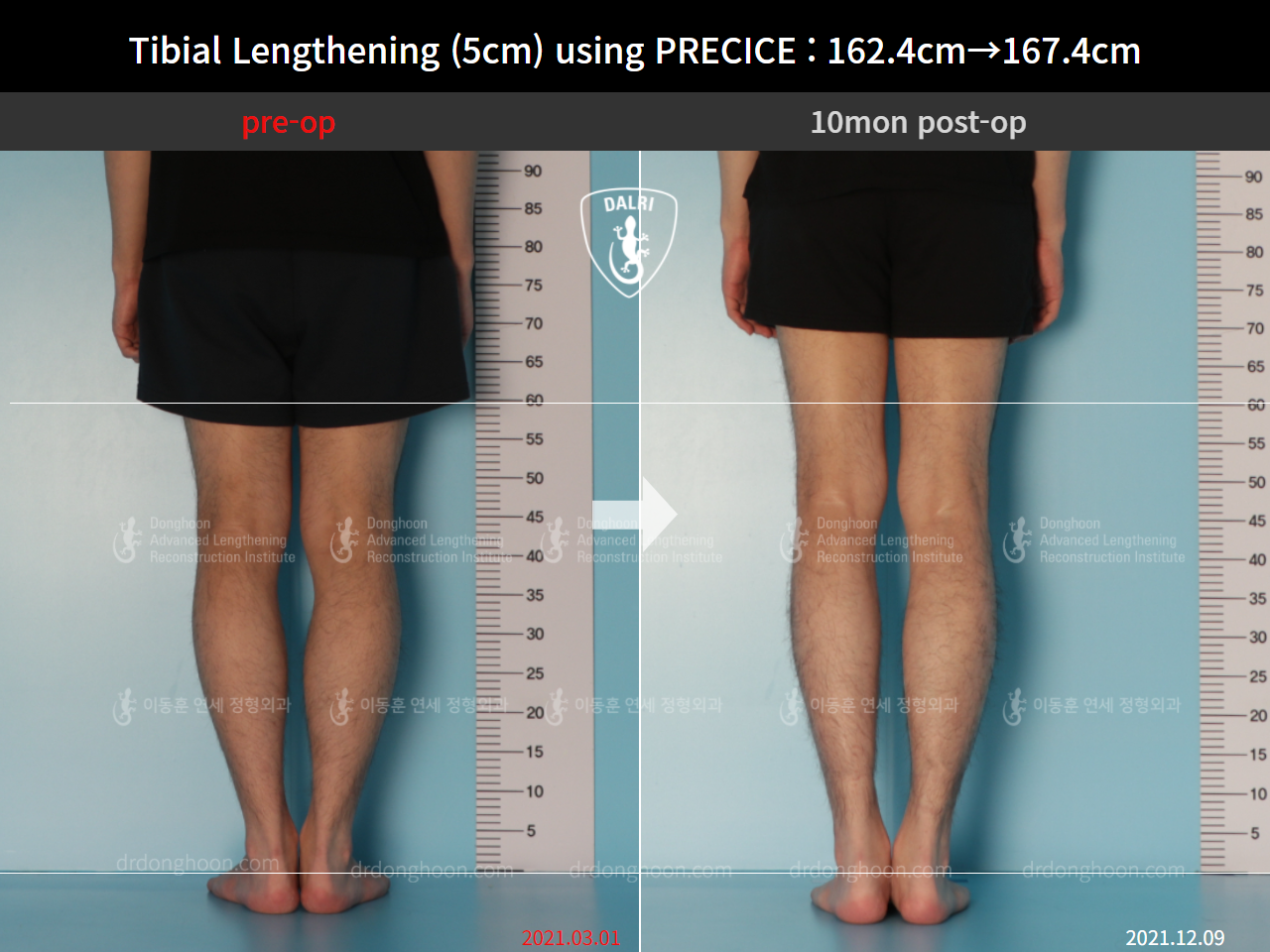 Before and after cll precice, case 9101885, image 6, Dr. Donghoon institute (DALRI)