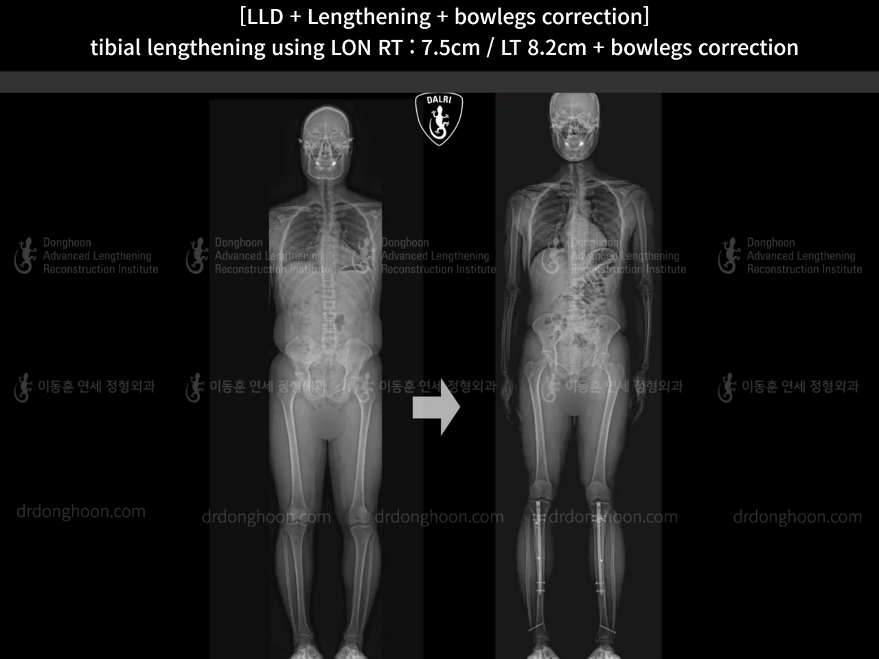 Before and after cll lon, case 14399776, image 5, Dr. Donghoon institute (DALRI)
