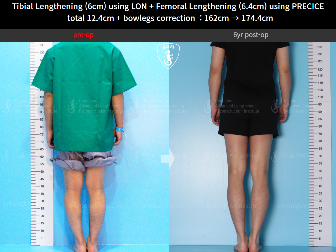Before and after cll precice, case 14631295, image 6, Dr. Donghoon institute (DALRI)