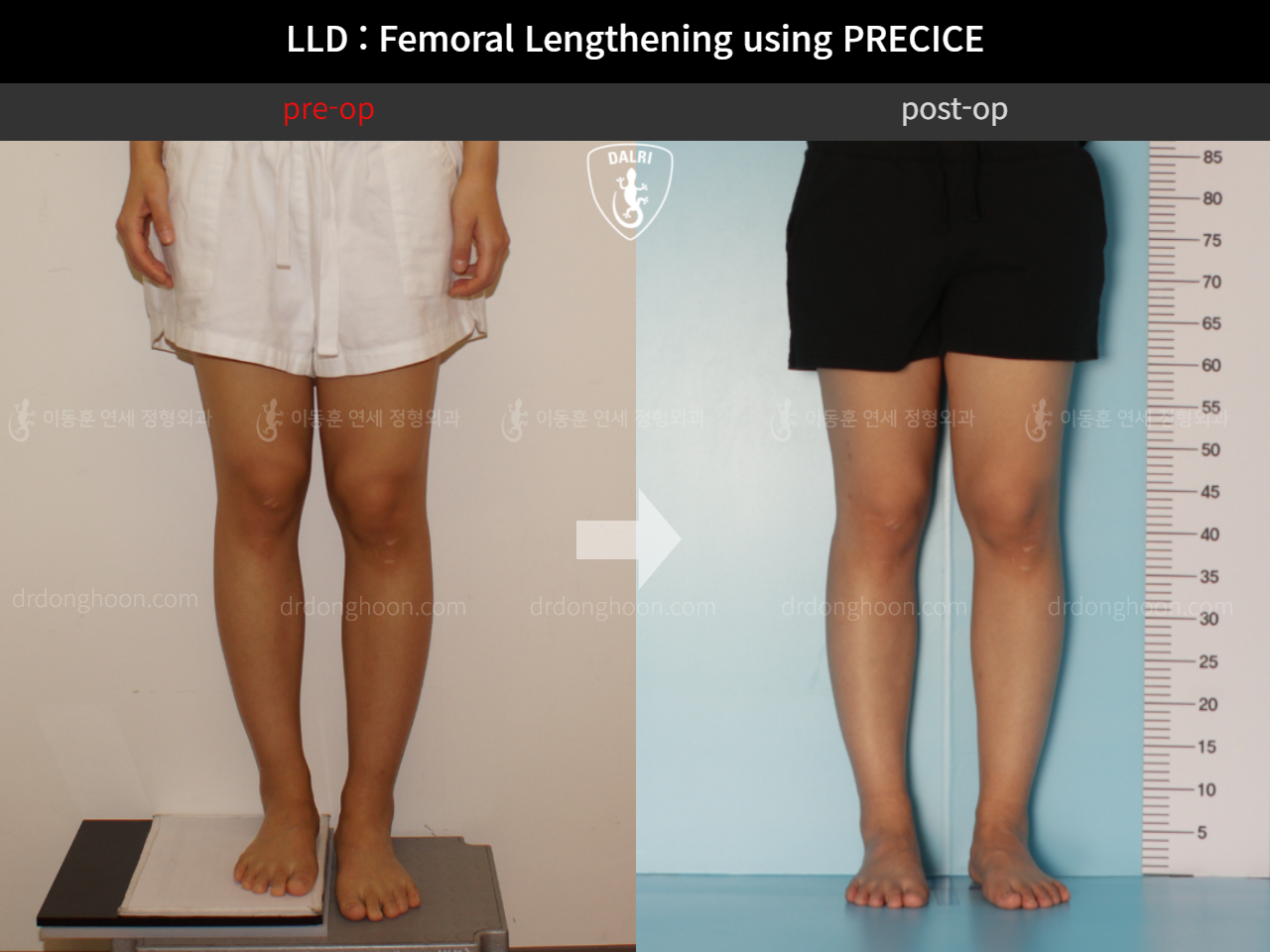 Before and after adult lld, case 10713336, image 3, Dr. Donghoon institute (DALRI)