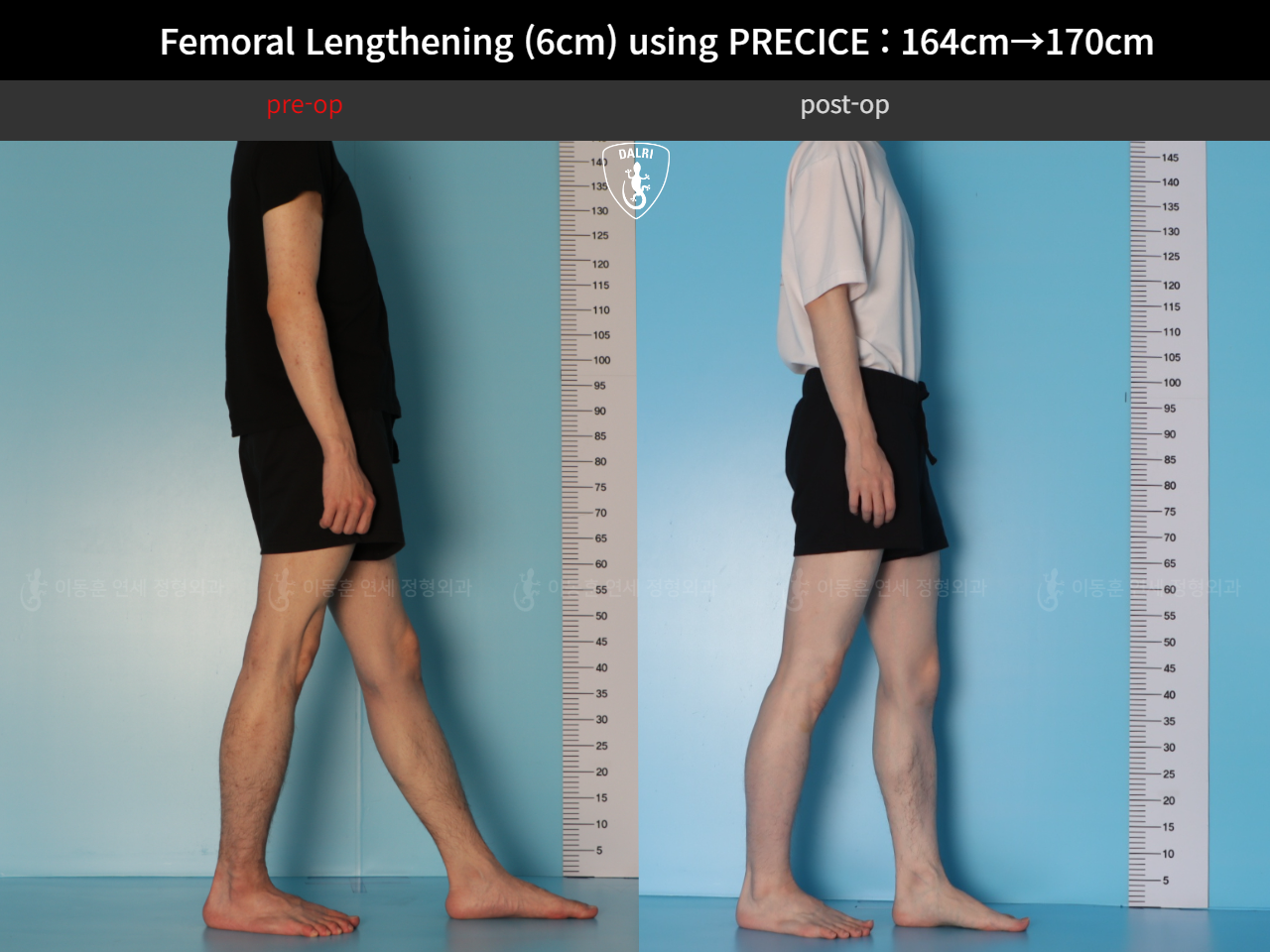 Before and after cll precice, case 33570290, image 4, Dr. Donghoon institute (DALRI)