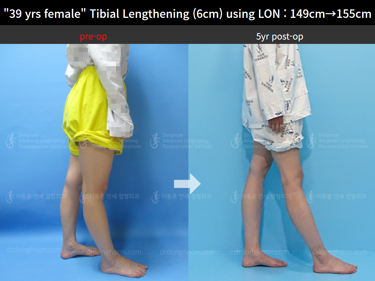 Before and after cll lon, case 8626950, image 3, Dr. Donghoon institute (DALRI)