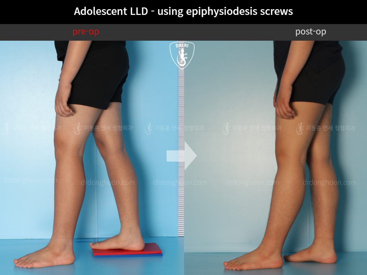 Before and after paediatric & adolescent lld, case 11472870, image 8, Dr. Donghoon institute (DALRI)
