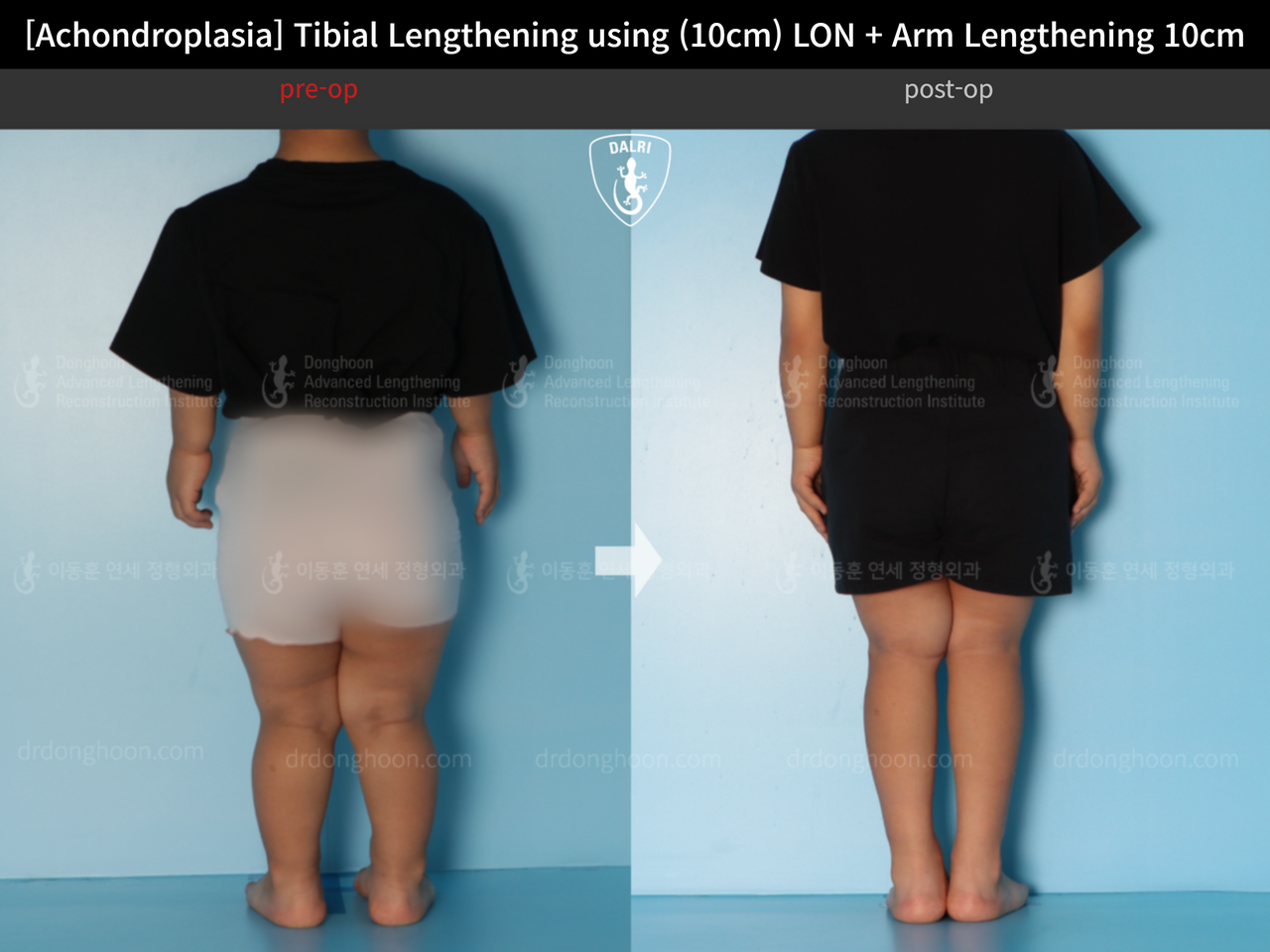 Before and after paediatric congenital condition, case 13864044, image 5, Dr. Donghoon institute (DALRI)