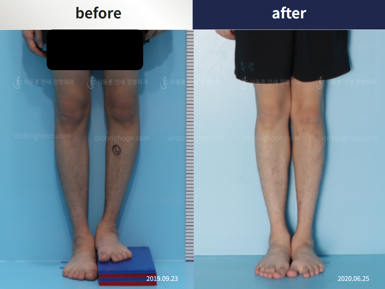 Before and after paediatric & adolescent lld, case 4684461, image 1, Dr. Donghoon institute (DALRI)