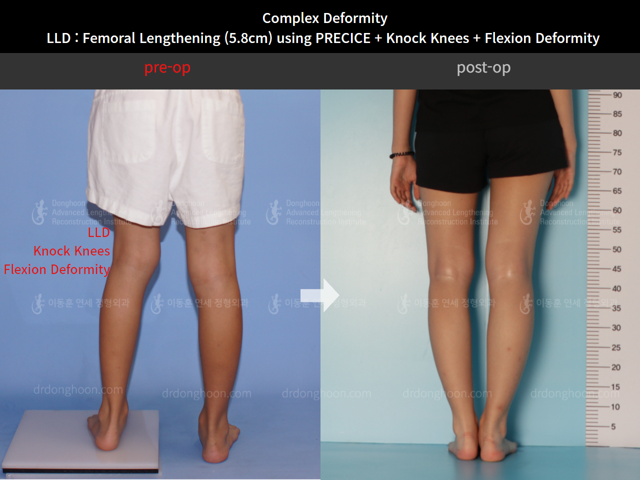 Before and after complex deformity, case 8790512, image 2, Dr. Donghoon institute (DALRI)