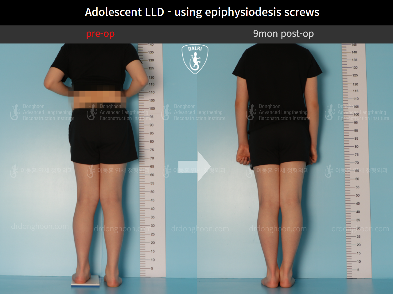 Before and after paediatric & adolescent lld, case 9572577, image 2, Dr. Donghoon institute (DALRI)