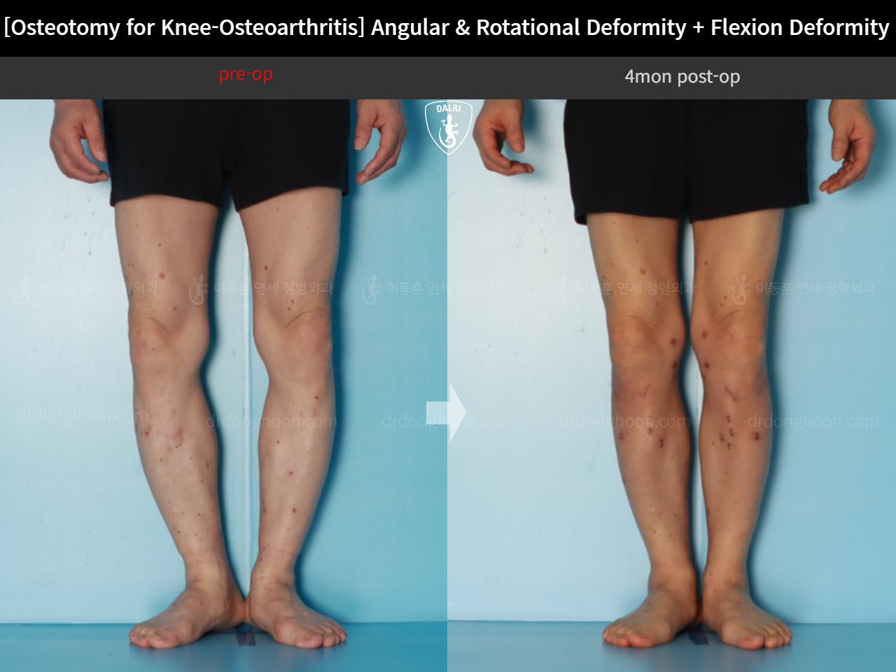 Before and after osteotomy for knee osteoarthritis, case 18162350, image 8, Dr. Donghoon institute (DALRI)