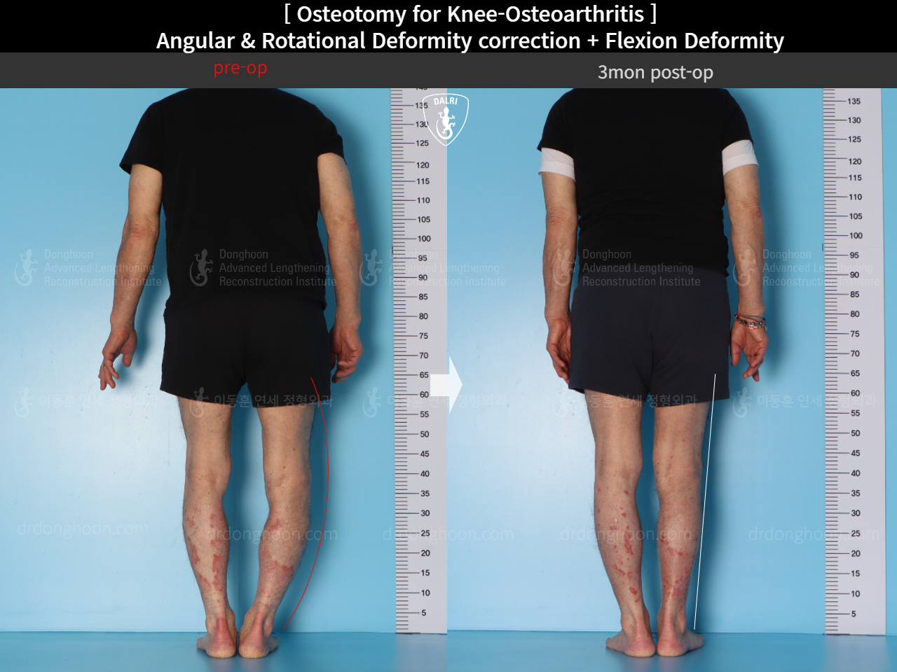 Before and after adult bowlegs, case 15362947, image 5, Dr. Donghoon institute (DALRI)