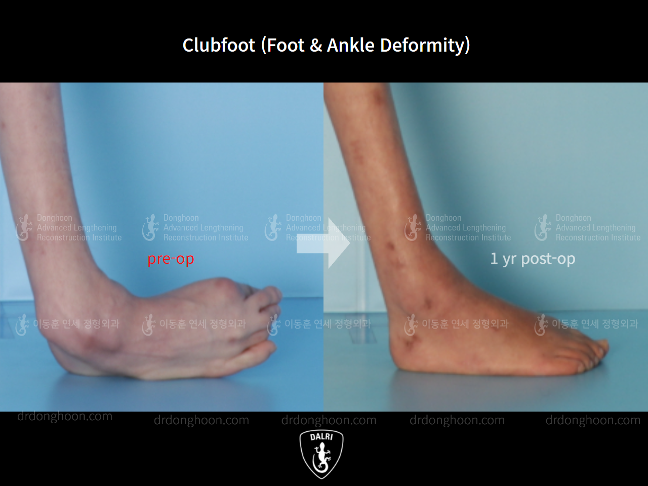 Before and after congenital clubfoot, case 9231529, image 6, Dr. Donghoon institute (DALRI)