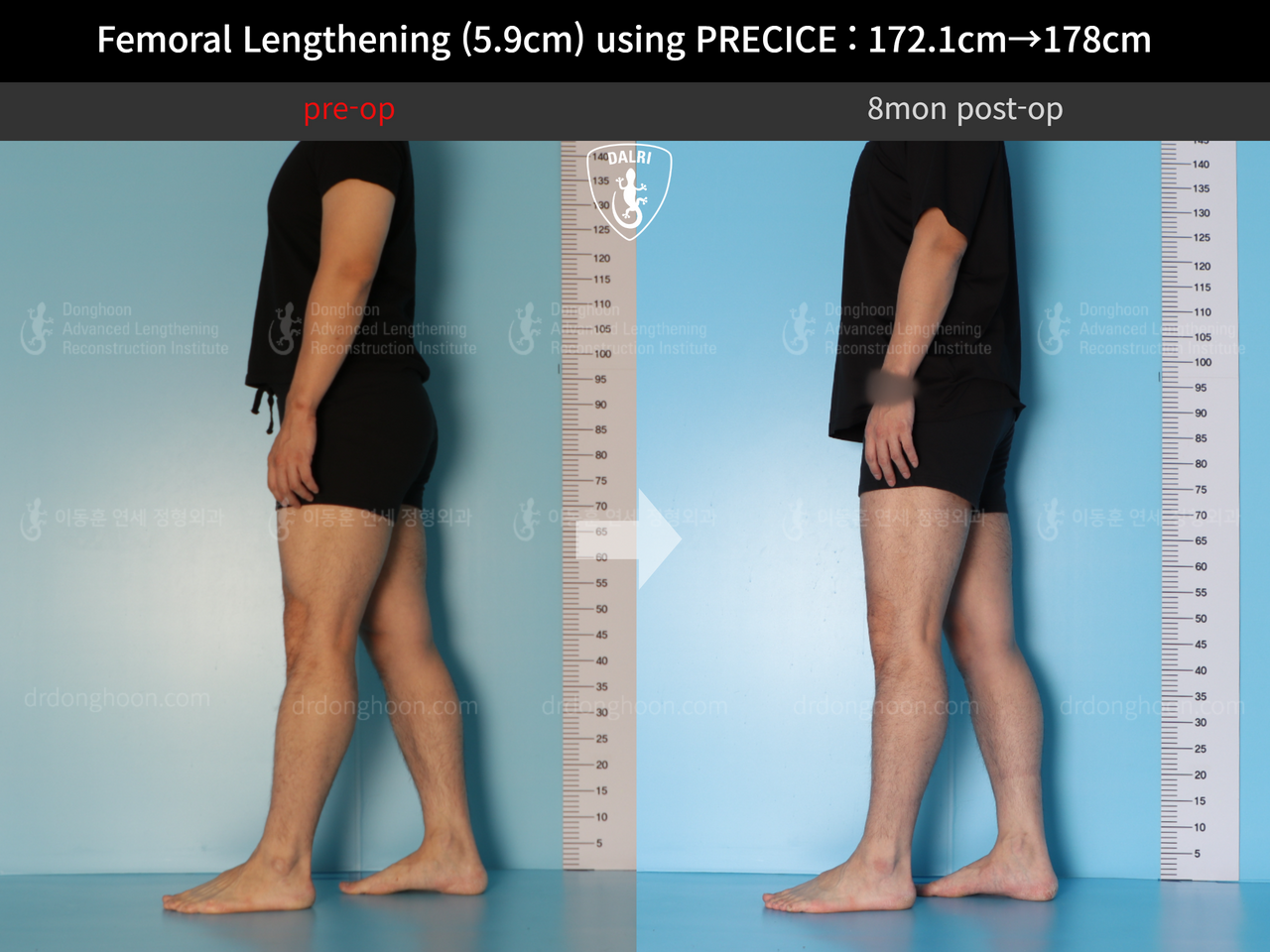 Before and after cll precice, case 13848850, image 6, Dr. Donghoon institute (DALRI)