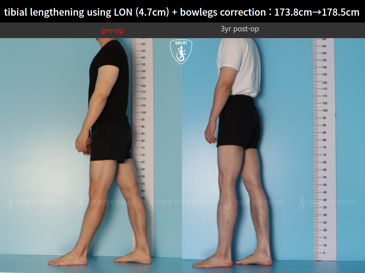 Before and after cll lon, case 128583026, image 6, Dr. Donghoon institute (DALRI)