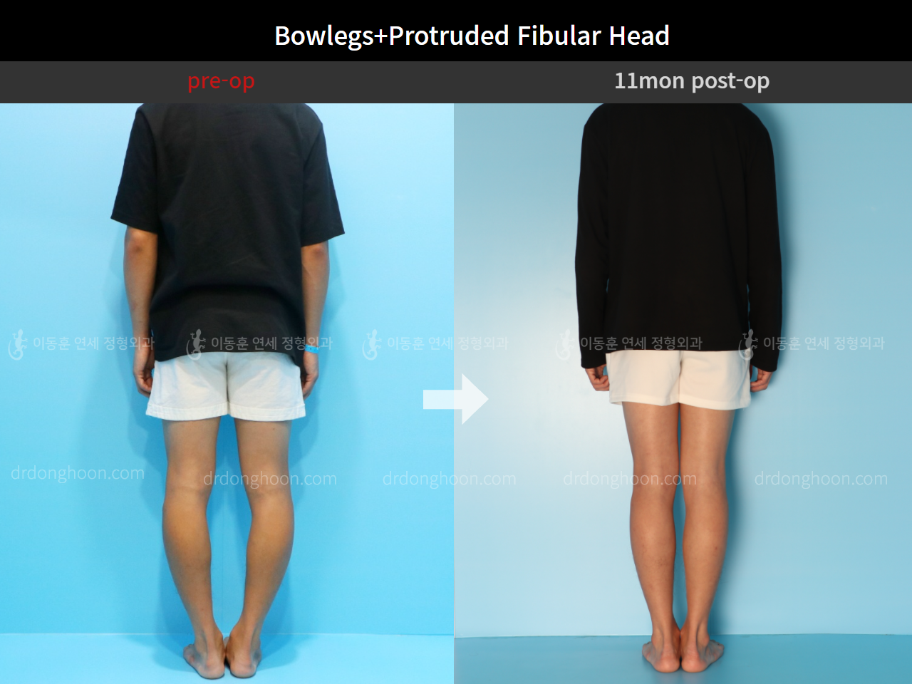 Before and after protruded fibular head, case 4248372, image 3, Dr. Donghoon institute (DALRI)