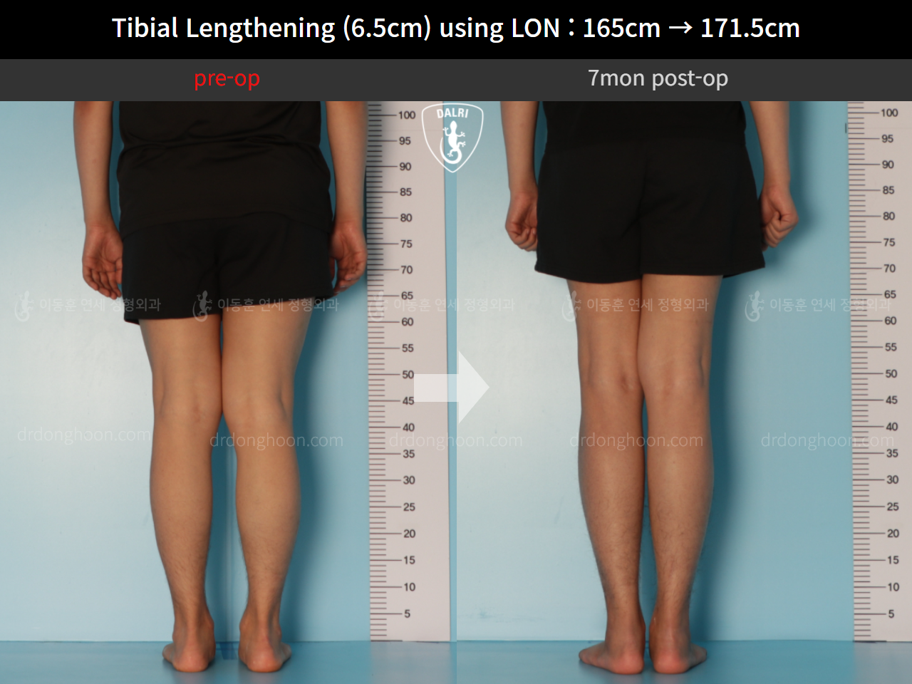 Before and after cll lon, case 10388000, image 6, Dr. Donghoon institute (DALRI)