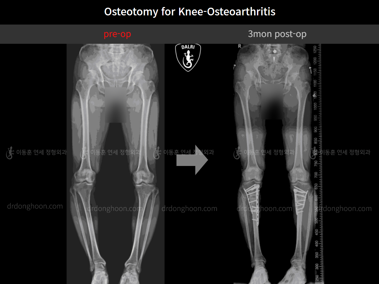 Before and after osteotomy for knee osteoarthritis, case 10445104, image 5, Dr. Donghoon institute (DALRI)