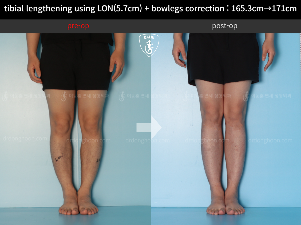 Tibial Lengthening Using LON(5.7cm) + Bowlegs Correction : 165.3cm→ ...