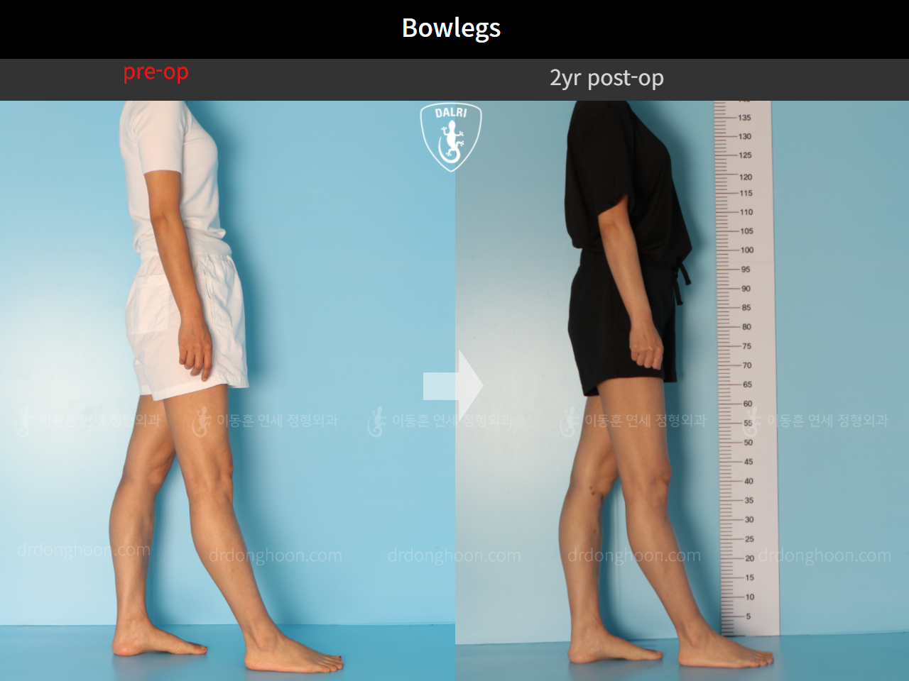 Before and after adult bowlegs, case 10023318, image 6, Dr. Donghoon institute (DALRI)